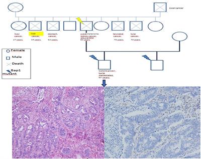 Case report: Mesothelioma and BAP1 tumor predisposition syndrome: Implications for public health
